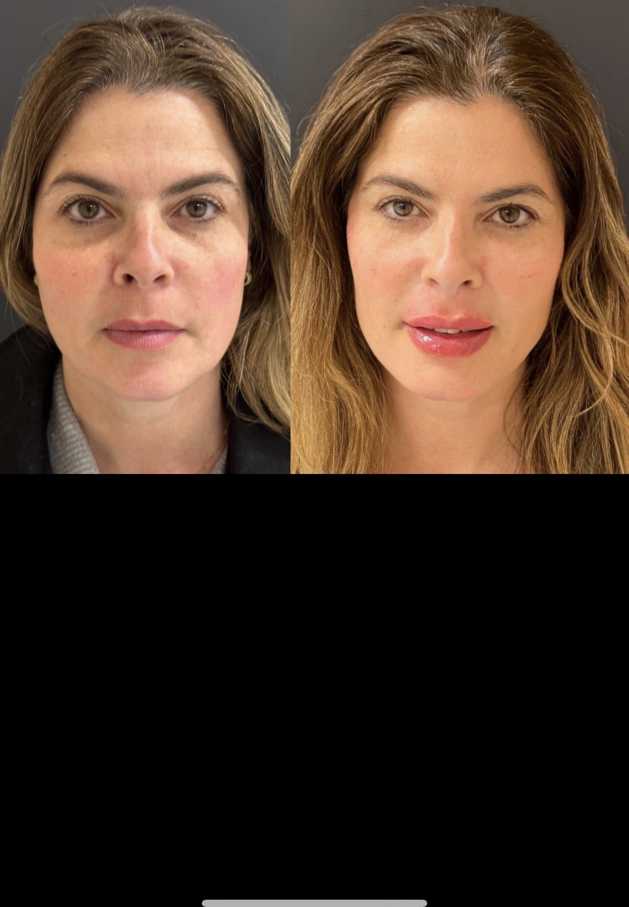 Antes e Depois Revitalização e Preenchimento Labial
