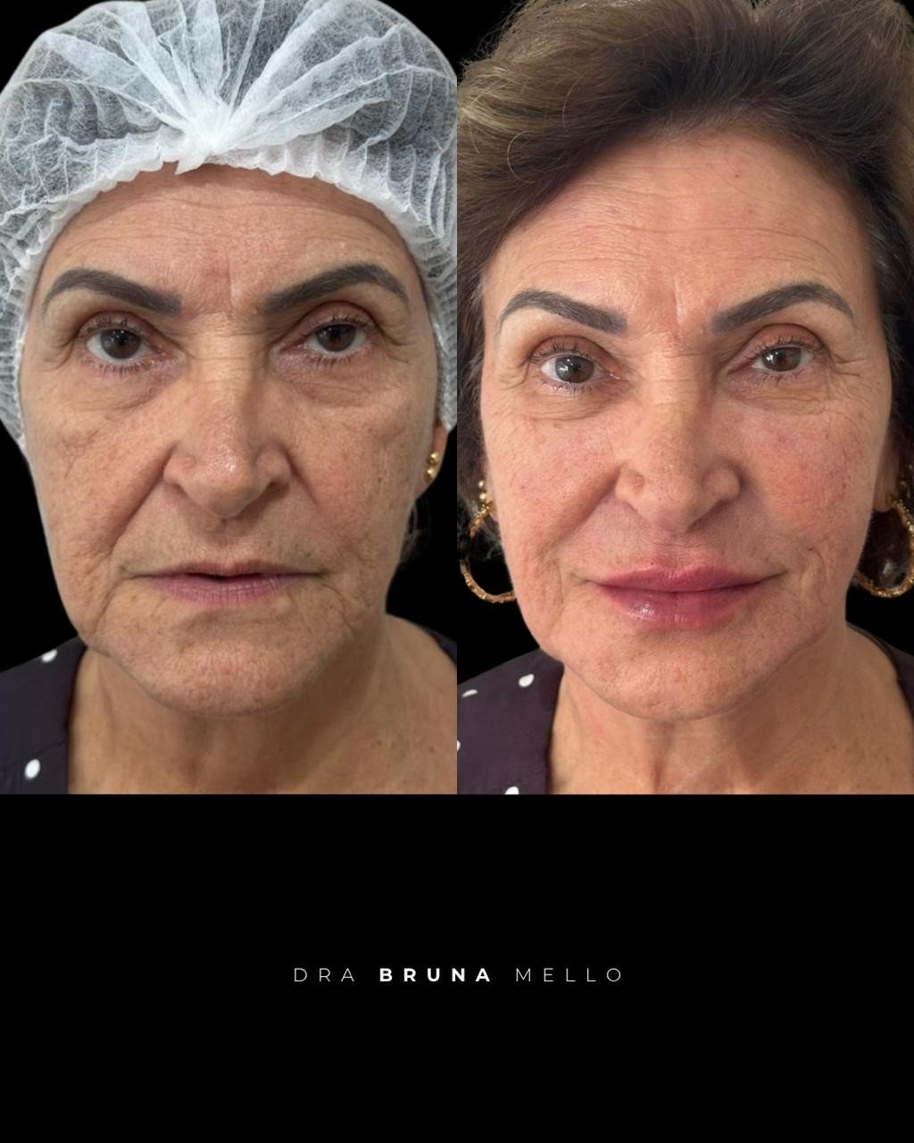 Antes e Depois Rejuvenescimento Global em Pele Madura