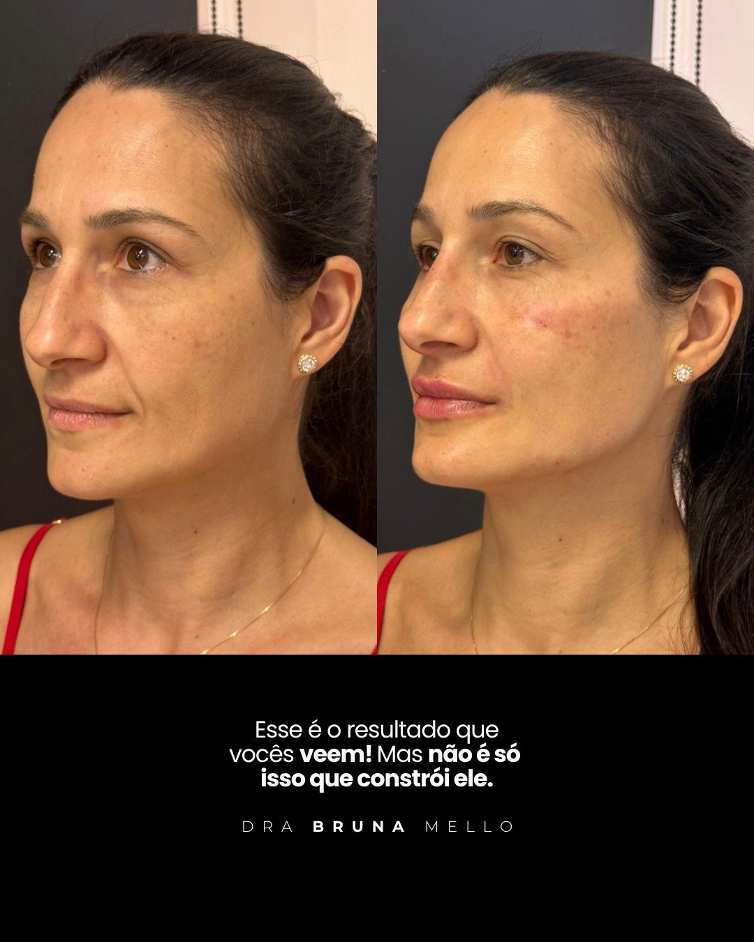 Antes e Depois Contorno e Linhas Faciais